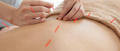 Can acupuncture cure back pain?