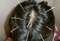 How Chinese acupuncture needles heal the hair loss ?