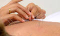 Chronic Low Back Pain Possibly can be cured by Acupuncture